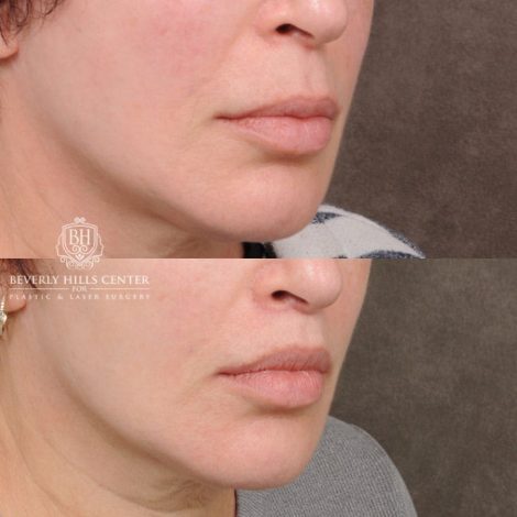 Beverly Hills Center Female Patient Before and After CUPID LIFT® Lip Lift