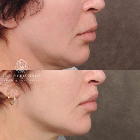 Beverly Hills Center Female Patient Before and After CUPID LIFT® Lip Lift
