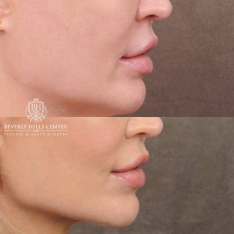 Beverly Hills Center Female Patient Before and After AuraLyft CUPID LIFT® Lip Lift