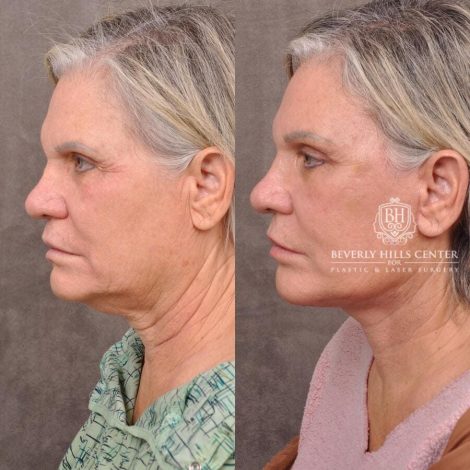 Beverly Hills Center Female Patient Before and After Patient 1 month post AuraLyft