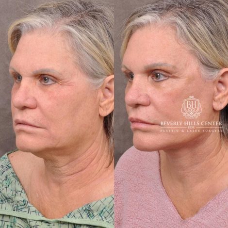 Beverly Hills Center Female Patient Before and After Patient 1 month post AuraLyft