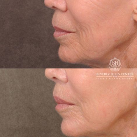 Beverly Hills Center Female Patient Before and After CUPID LIFT® Lip Lift