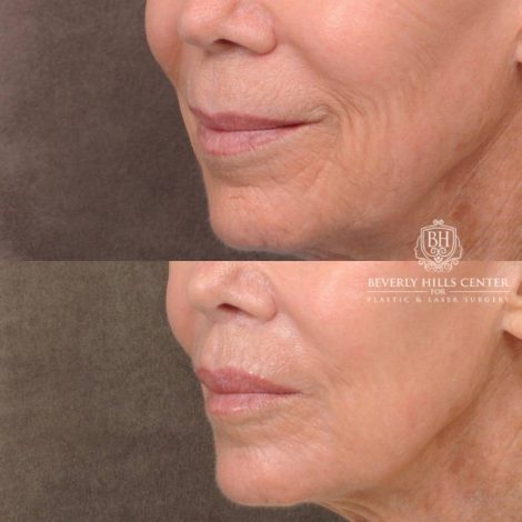 Beverly Hills Center Female Patient Before and After CUPID LIFT® Lip Lift