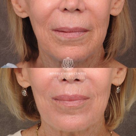 Beverly Hills Center Female Patient Before and After CUPID LIFT® Lip Lift