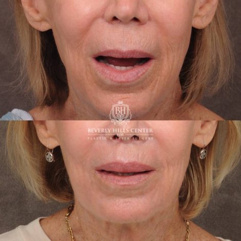 Beverly Hills Center Female Patient Before and After CUPID LIFT® Lip Lift