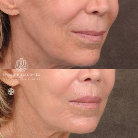 Beverly Hills Center Female Patient Before and After CUPID LIFT® Lip Lift