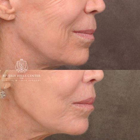 Beverly Hills Center Female Patient Before and After CUPID LIFT® Lip Lift