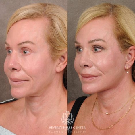 Beverly Hills Center Female Patient Before and After AuraLyft & CUPID LIFT® Corner Lift