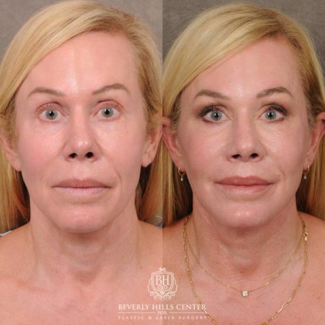 Beverly Hills Center Female Patient Before and After AuraLyft & CUPID LIFT® Corner Lift