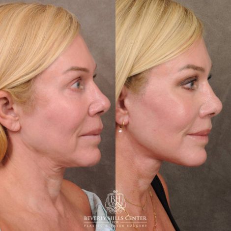 Beverly Hills Center Female Patient Before and After AuraLyft & CUPID LIFT® Corner Lift