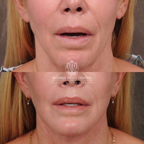 Beverly Hills Center Female Patient Before and After AuraLyft & CUPID LIFT® Corner Lift