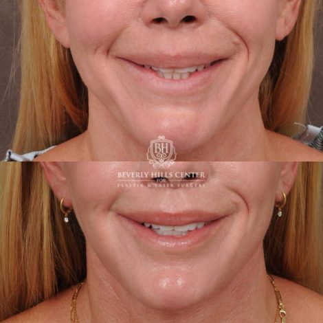 Beverly Hills Center Female Patient Before and After AuraLyft & CUPID LIFT® Corner Lift