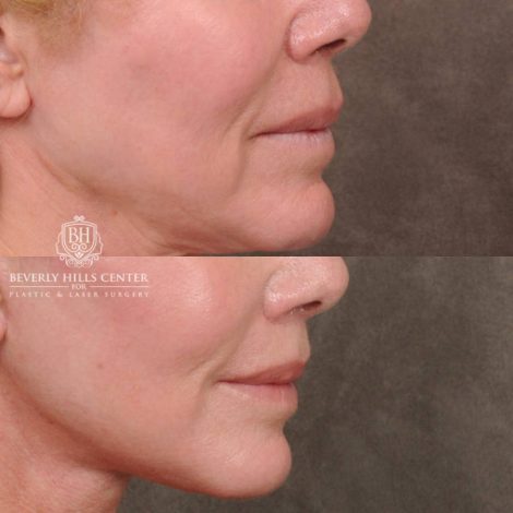 Beverly Hills Center Female Patient Before and After AuraLyft & CUPID LIFT® Corner Lift