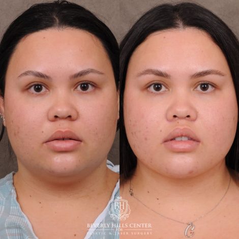Beverly Hills Center Female Patient Before and After CUPID LIFT® Lip Lift & Weekend Necklift