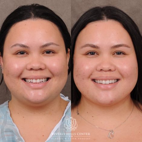 Beverly Hills Center Female Patient Before and After CUPID LIFT® Lip Lift & Weekend Necklift