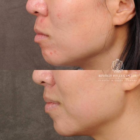 Beverly Hills Center Female Patient Before and After CUPID LIFT® Lip Lift
