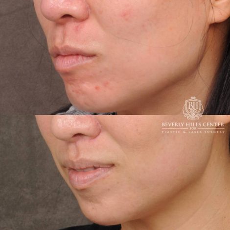 Beverly Hills Center Female Patient Before and After CUPID LIFT® Lip Lift