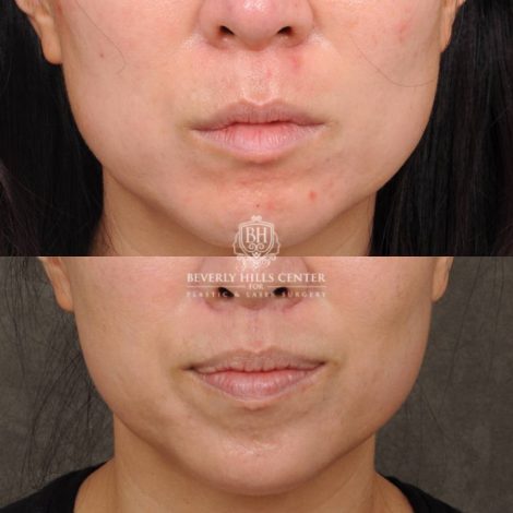 Beverly Hills Center Female Patient Before and After CUPID LIFT® Lip Lift