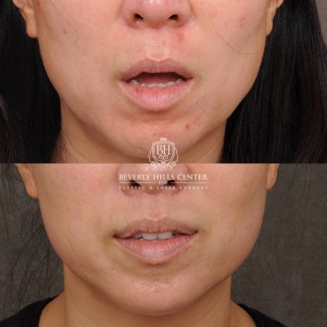 Beverly Hills Center Female Patient Before and After CUPID LIFT® Lip Lift