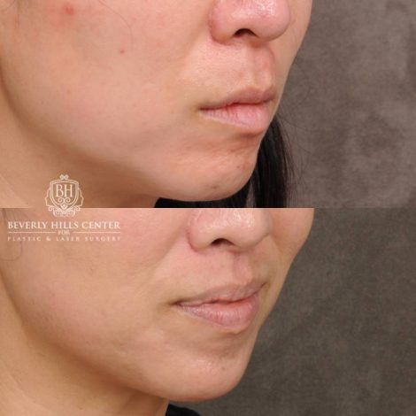 Beverly Hills Center Female Patient Before and After CUPID LIFT® Lip Lift