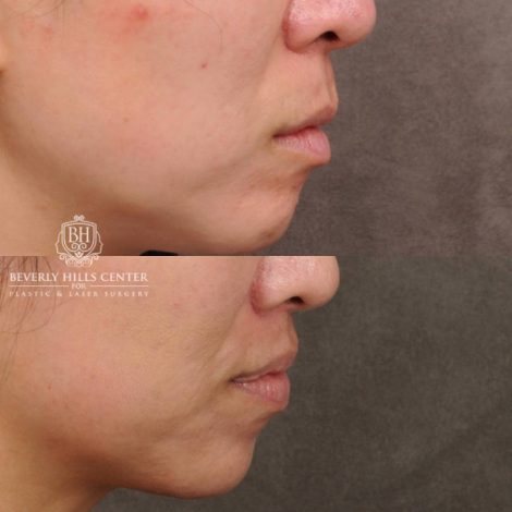 Beverly Hills Center Female Patient Before and After CUPID LIFT® Lip Lift