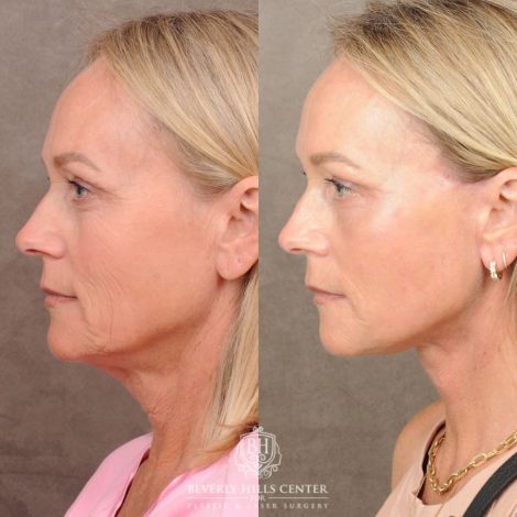 Beverly Hills Center Female Patient Before and After AuraLyft