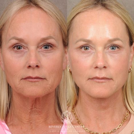 Beverly Hills Center Female Patient Before and After AuraLyft