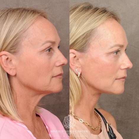 Beverly Hills Center Female Patient Before and After AuraLyft