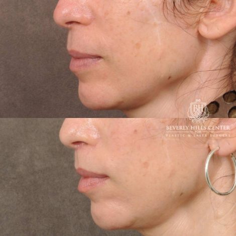 Beverly Hills Center Female Patient Before and After CUPID LIFT® Lip Lift