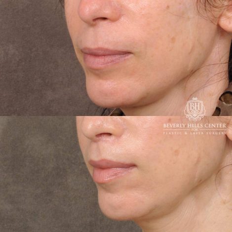 Beverly Hills Center Female Patient Before and After CUPID LIFT® Lip Lift