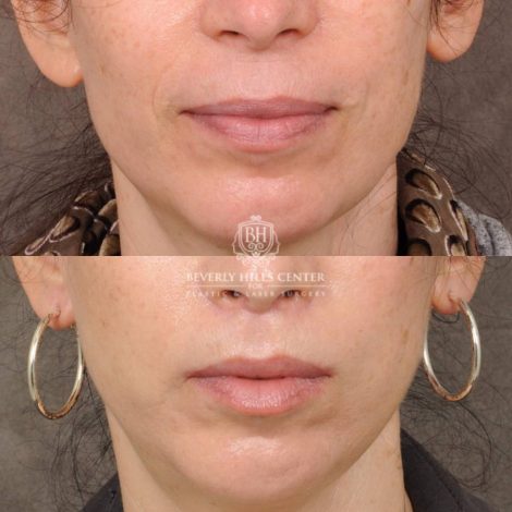 Beverly Hills Center Female Patient Before and After CUPID LIFT® Lip Lift