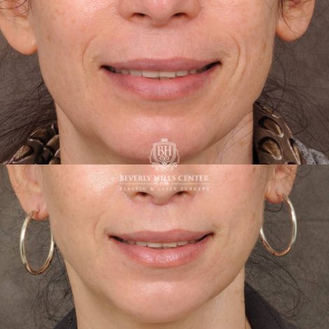 Beverly Hills Center Female Patient Before and After CUPID LIFT® Lip Lift