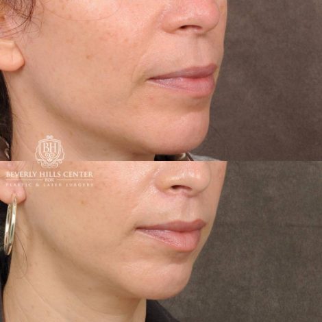 Beverly Hills Center Female Patient Before and After CUPID LIFT® Lip Lift