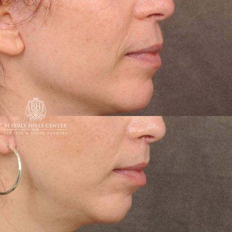 Beverly Hills Center Female Patient Before and After CUPID LIFT® Lip Lift