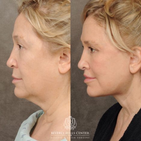Beverly Hills Center Female Patient Before and After Comprehensive AuraLyft – AuraLyft, Upper & Lower Blepharoplasty, Brow Lift, CUPID LIFT®