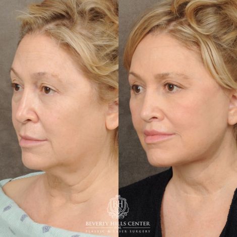 Beverly Hills Center Female Patient Before and After Comprehensive AuraLyft – AuraLyft, Upper & Lower Blepharoplasty, Brow Lift, CUPID LIFT®