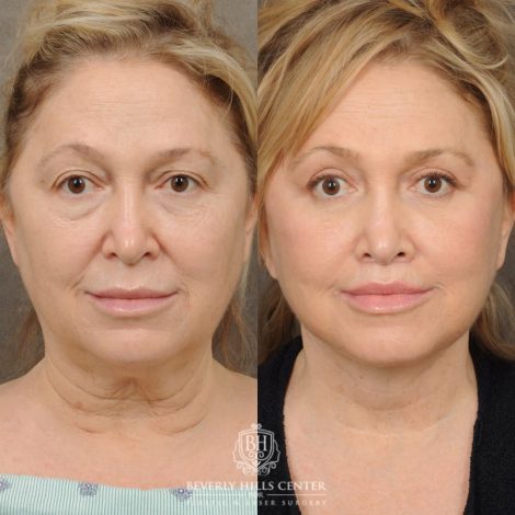 Beverly Hills Center Female Patient Before and After Comprehensive AuraLyft – AuraLyft, Upper & Lower Blepharoplasty, Brow Lift, CUPID LIFT®