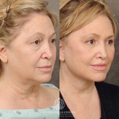 Beverly Hills Center Female Patient Before and After Comprehensive AuraLyft – AuraLyft, Upper & Lower Blepharoplasty, Brow Lift, CUPID LIFT®