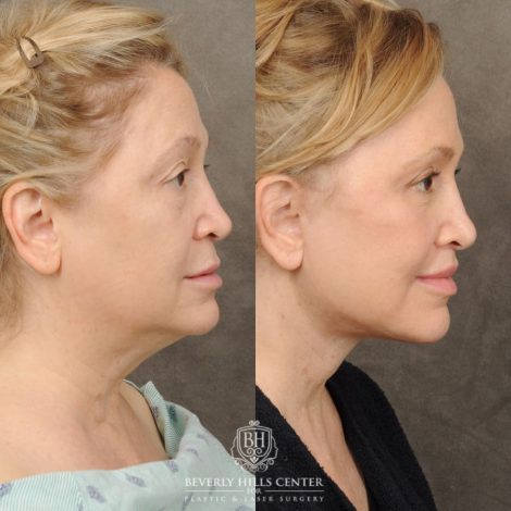Beverly Hills Center Female Patient Before and After Comprehensive AuraLyft – AuraLyft, Upper & Lower Blepharoplasty, Brow Lift, CUPID LIFT®