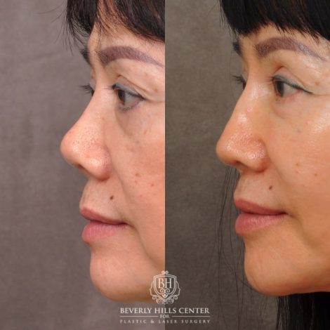 Beverly Hills Center Female Patient Before and After Revision Rhinoplasty, Chin Implant, Profound RF (Chin & Neck)