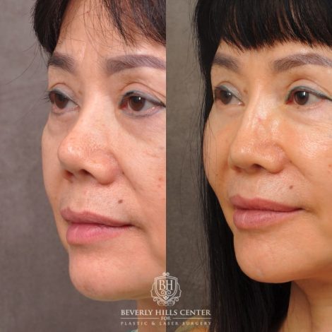 Beverly Hills Center Female Patient Before and After Revision Rhinoplasty, Chin Implant, Profound RF (Chin & Neck)