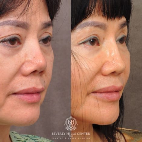Beverly Hills Center Female Patient Before and After Revision Rhinoplasty, Chin Implant, Profound RF (Chin & Neck)