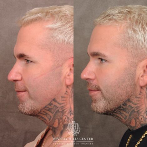 Beverly Hills Center Female Patient Before and After Brow Lift, CUPID LIFT® Lip Lift