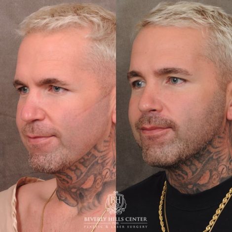 Beverly Hills Center Female Patient Before and After Brow Lift, CUPID LIFT® Lip Lift