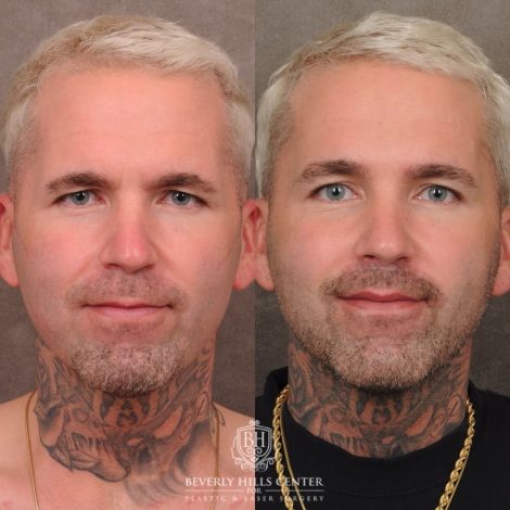 Beverly Hills Center Female Patient Before and After Brow Lift, CUPID LIFT® Lip Lift