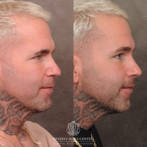 Beverly Hills Center Female Patient Before and After Brow Lift, CUPID LIFT® Lip Lift