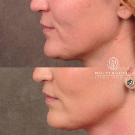 Beverly Hills Center Female Patient Before and After CUPID LIFT® Lip Lift