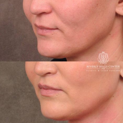 Beverly Hills Center Female Patient Before and After CUPID LIFT® Lip Lift
