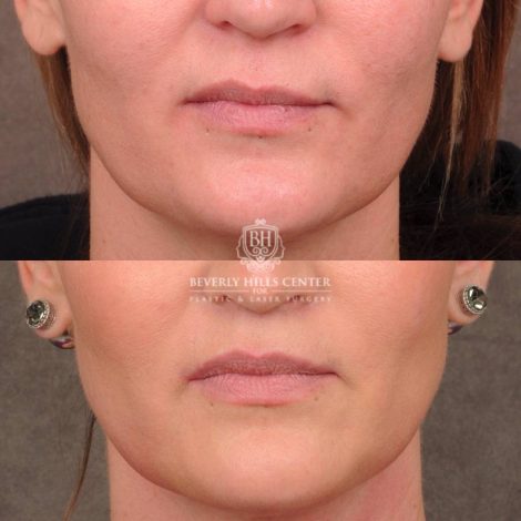 Beverly Hills Center Female Patient Before and After CUPID LIFT® Lip Lift