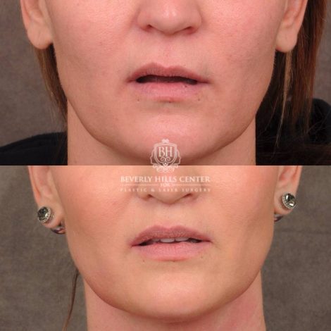 Beverly Hills Center Female Patient Before and After CUPID LIFT® Lip Lift